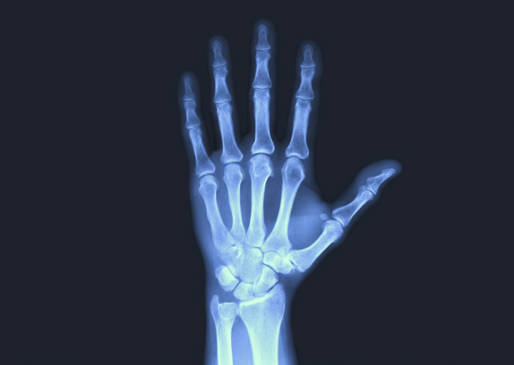 Radiographie de la main